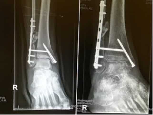 Rontgenfoto fysiotherapie