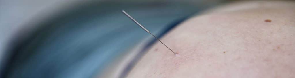 dry needling alkmaar